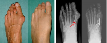 Hallux valgus