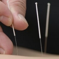 Acupunctura - tratament acupunctura - scalpel - informatii medicale si portal educational