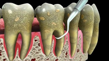 Fogászati ​​implantátumok parodontitis, árak és költségek, a technológia és ellenjavallatok