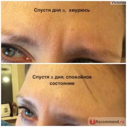 Injecțiile cu Botox - 