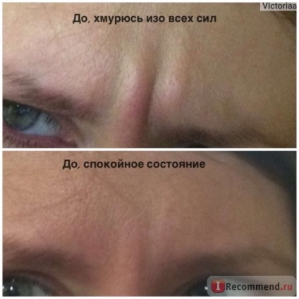 Botox injekciók - „Nem értem a hatásait, vagy először a szemöldökök között fotó előtt és után” vélemény