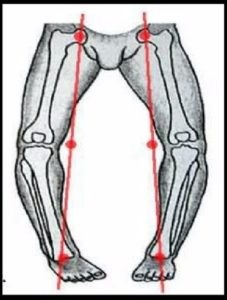 Cum să corectați picioarele curbate, fie că se poate face cu operația și fără copil și adult, fete și