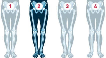 Cum să corectați picioarele curbate, fie că se poate face cu operația și fără copil și adult, fete și