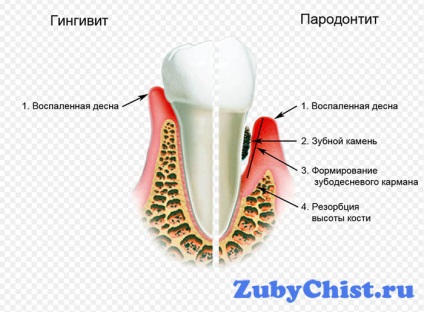 Cum să tratați boala parodontală a gumei alveolare