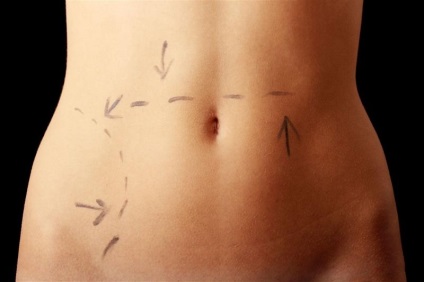 Cum să piardă în greutate sub abdominoplastia și liposucția scalpelului