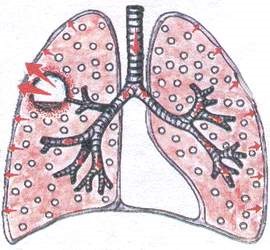 Chistul tipurilor pulmonare, cauzele, simptomele și modalitățile de tratament