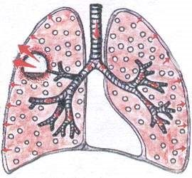 Lung ciszta típusok, okoz, tünetek és kezelési módszerek