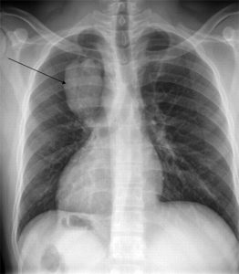 Lung ciszta típusok, okoz, tünetek és kezelési módszerek