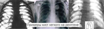 Lung ciszta típusok, okoz, tünetek és kezelési módszerek