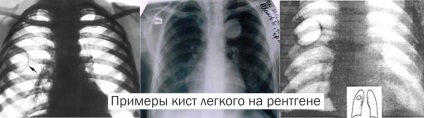 Chistul tipurilor pulmonare, cauzele, simptomele și modalitățile de tratament