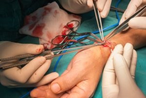 Kezelése arteriovenosus fistula Izraelben - a legújabb technikákat