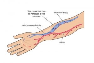 Tratamentul fistulei arteriovenoase în Israel - cele mai recente tehnici