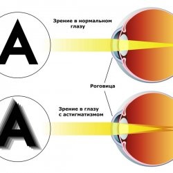 Tratamentul astigmatismului în medicina netradițională - bisturiu - medical