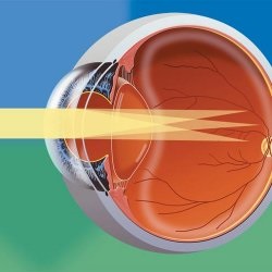 Tratamentul astigmatismului în medicina netradițională - bisturiu - medical
