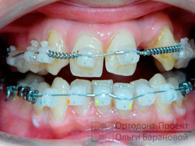 Tratamentul armăturilor înainte de proteza dinților