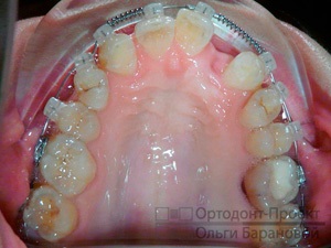 Tratamentul armăturilor înainte de proteza dinților