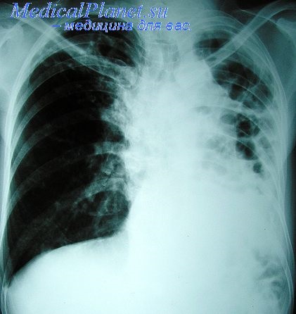 Tratamentul tuberculozei pediatrice
