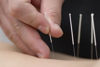 Tratamentul acupuncturii în esența acestei tehnici alternative