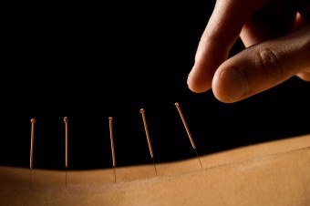 Tratamentul acupuncturii în esența acestei tehnici alternative