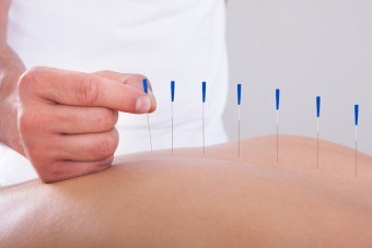Tratamentul acupuncturii în esența acestei tehnici alternative