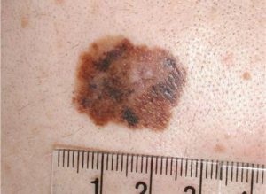 Tratamentul folic remedii melanom