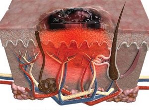 Melanoma kezelése népi orvosság - hogy lehet-e