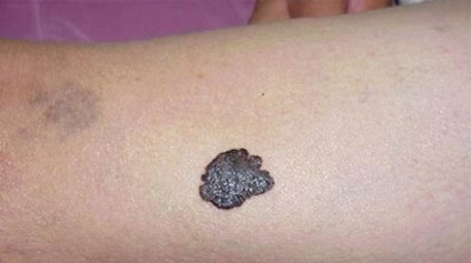 melanoma otthoni kezelési módszerek leírása, véleménye, szakértők véleményét, a következmények