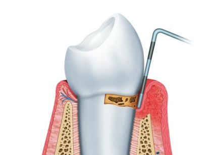 Tratamentul sclerozei multiple cu remedii folclorice