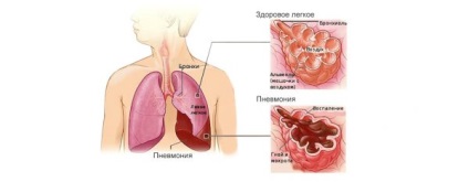 Plămânii după consumul de alcool suflă cauzele și pericolele