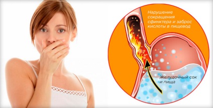 Gyógyszerek gyomorégés terhes nők, hogy mit kell tenni a gyomorégés, savas reflux okai
