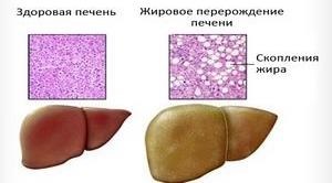 Limonada este un ucigaș sau ceea ce este periculos sunt băuturile dulci, diabetul zaharat, hepatoza grasă, rezistența la insulină,