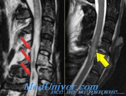 Diagnosticul radiologic al rănilor spinale