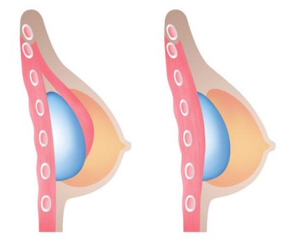 Mamoplastia - întregul adevăr