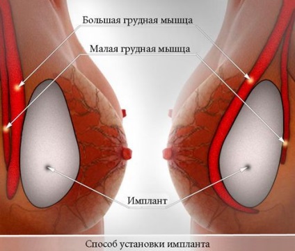 Implantátumok - az egész meztelen igazság