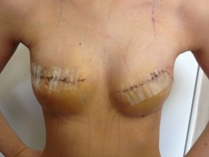 Mastectomie (chirurgie pentru îndepărtarea cancerului) tipuri de sân, complicații și recuperare