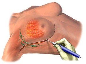 Mastectomie (chirurgie pentru eliminarea cancerului) tipuri de sân, complicații și recuperare