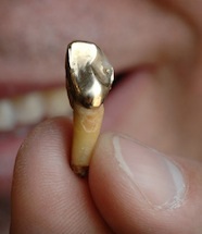 Coroane metalice pe dinți - cum se instalează coroanele ștanțate și împodobite