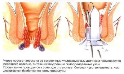 Metode și metode de tratament a hemoroizilor