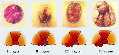 Metode și metode de tratament a hemoroizilor