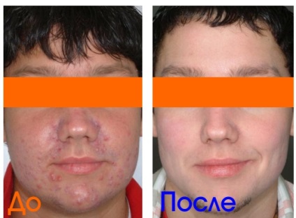 Cosmetica bărbaților în clinica dasclinic - proceduri populare de cosmetică pentru bărbați