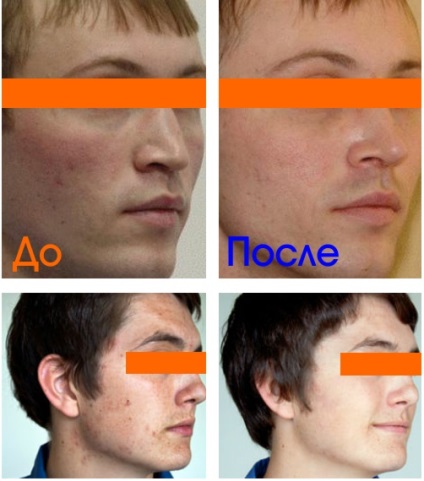 Cosmetica bărbaților în clinica dasclinic - proceduri populare de cosmetică pentru bărbați