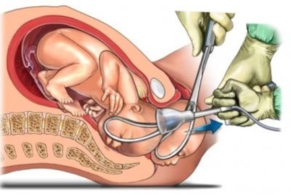 Impunerea forcepsului obstetric la livrare