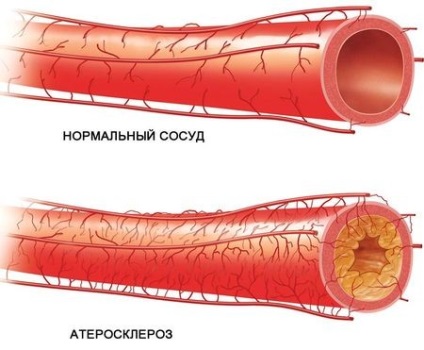 Lipid anyagcsere típusok, okok, tünetek és a kezelés