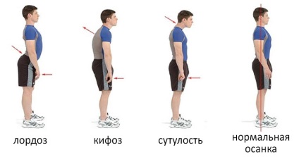 Încălcarea posturii - tipuri, cauze, tratament și prevenire