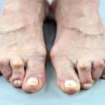 Hány napig így beteg osteochondrosis (mennyit) Hány napig adni beteg osteochondrosis