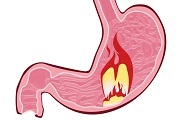 Neuroza stomacului - cauze, simptome, tratament