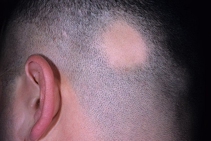 Alopecia areata