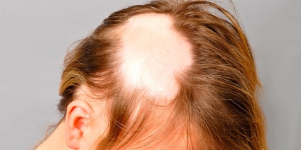 Alopecia areata la femeile care cauzeaza si tratamentul pierderii severe a parului