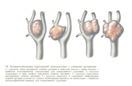 Tumora peste claviculă cum se identifică și se tratează