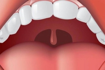 Umflarea limbii în gât - ce trebuie să facă - informații despre sănătate